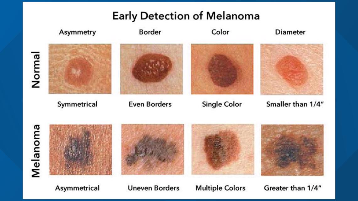 Sunny spring days increase the risk of melanoma and other skin cancers