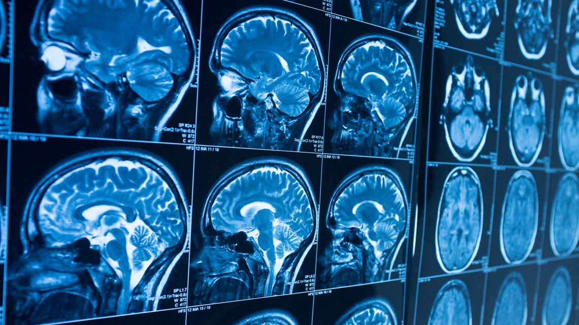 What is ALS? West Michigan doctor explains symptoms, prognosis after Eric Dane's death