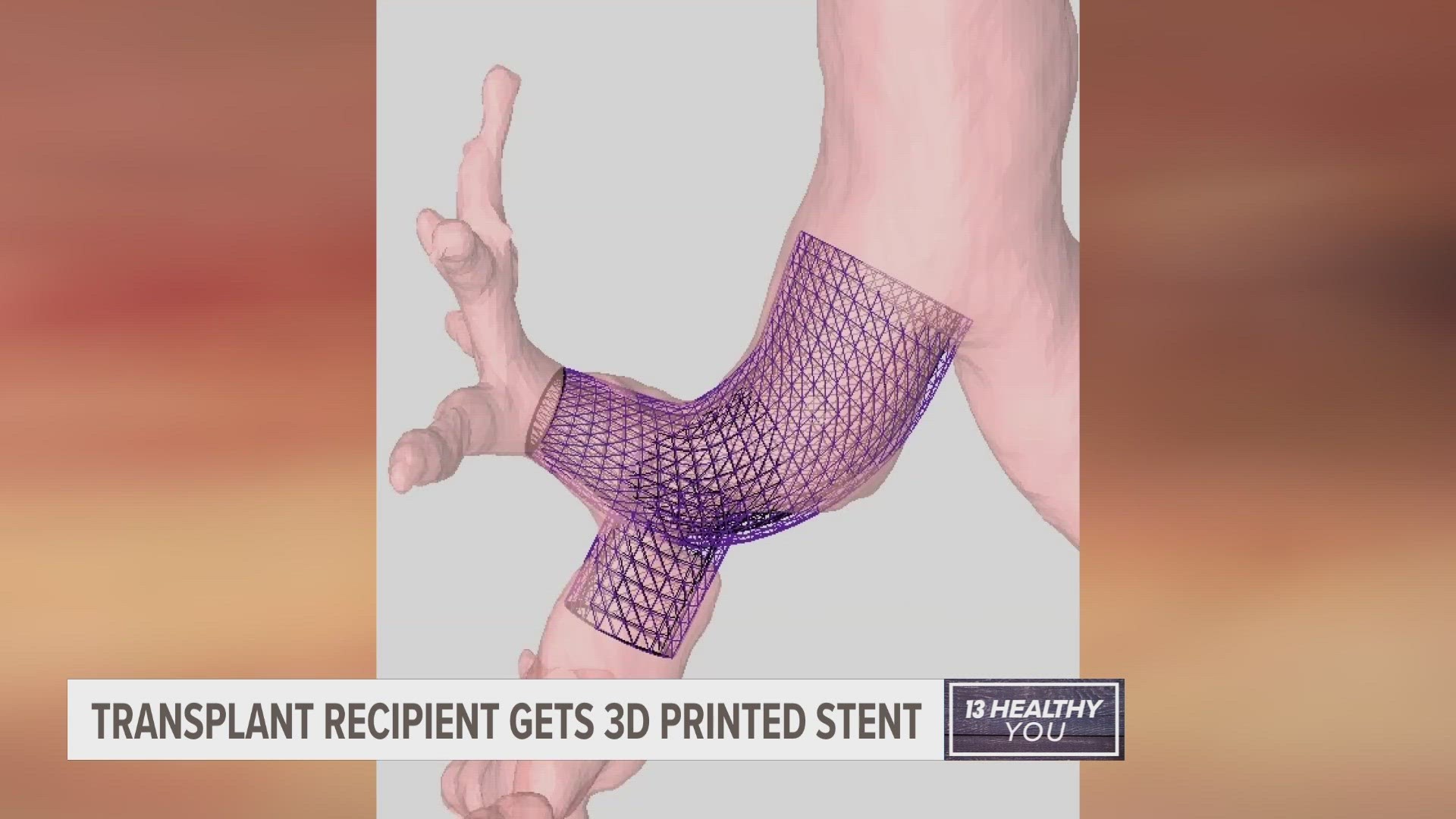 The 3D printed silicone stent for Wayne Morgan's lung airway is the first of its kind at Corewell Health.