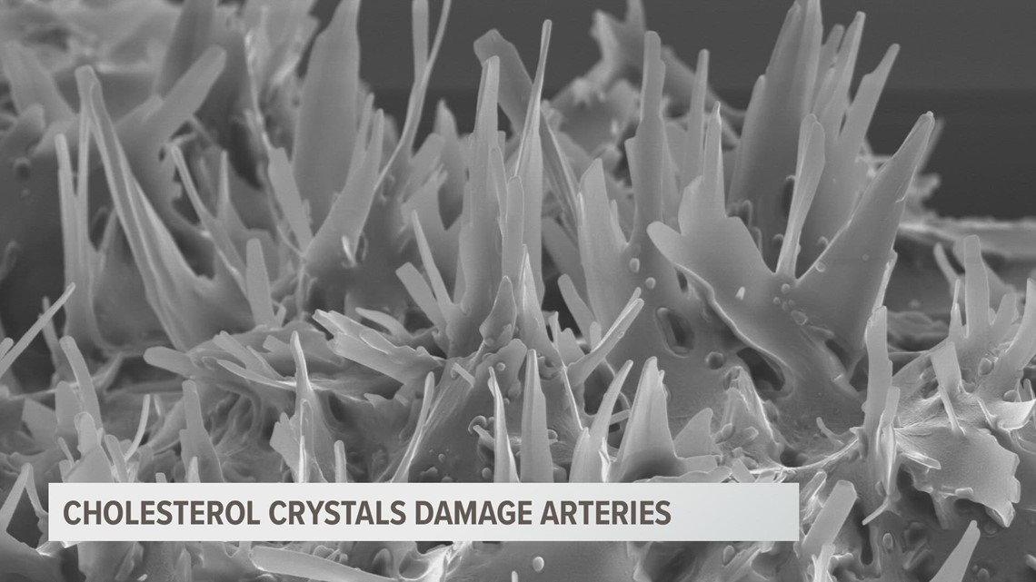 Are cholesterol crystals causing hearts attacks?