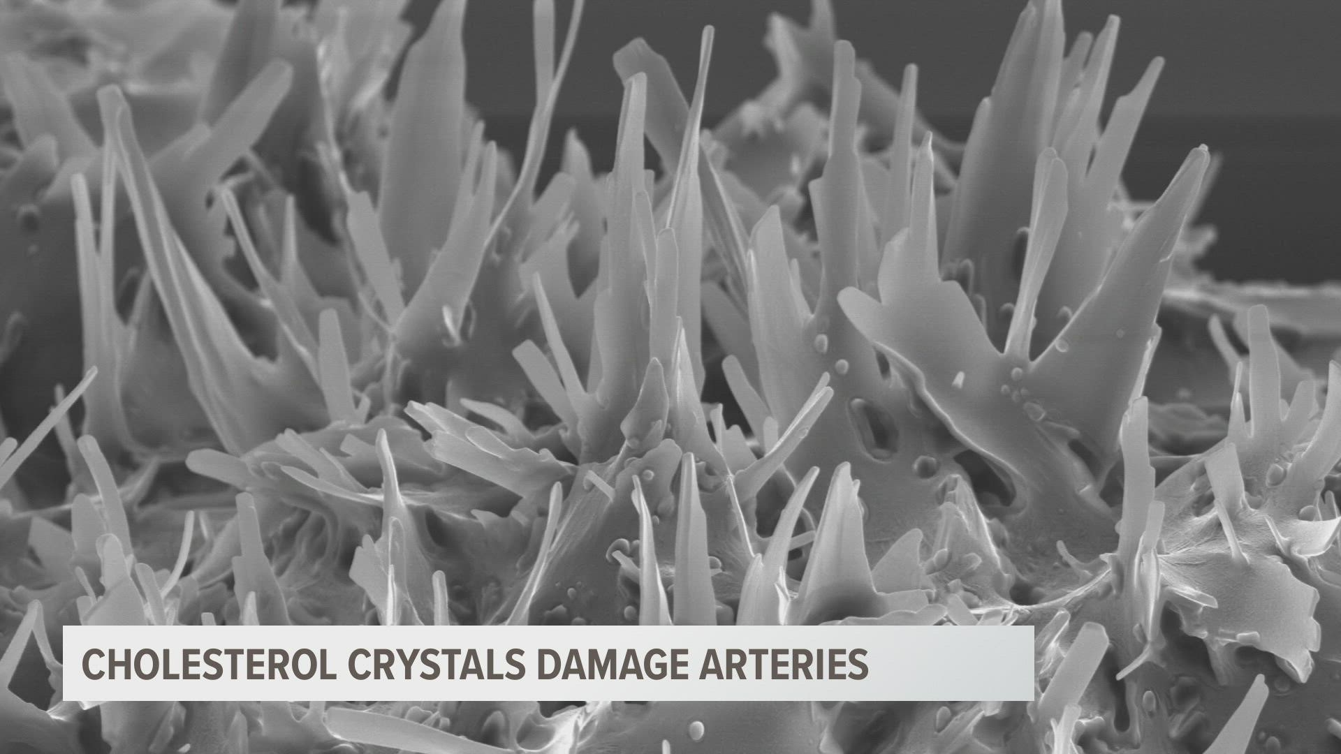 Cholesterol crystals sharp as needles can tear through arteries prior to a heart attack.