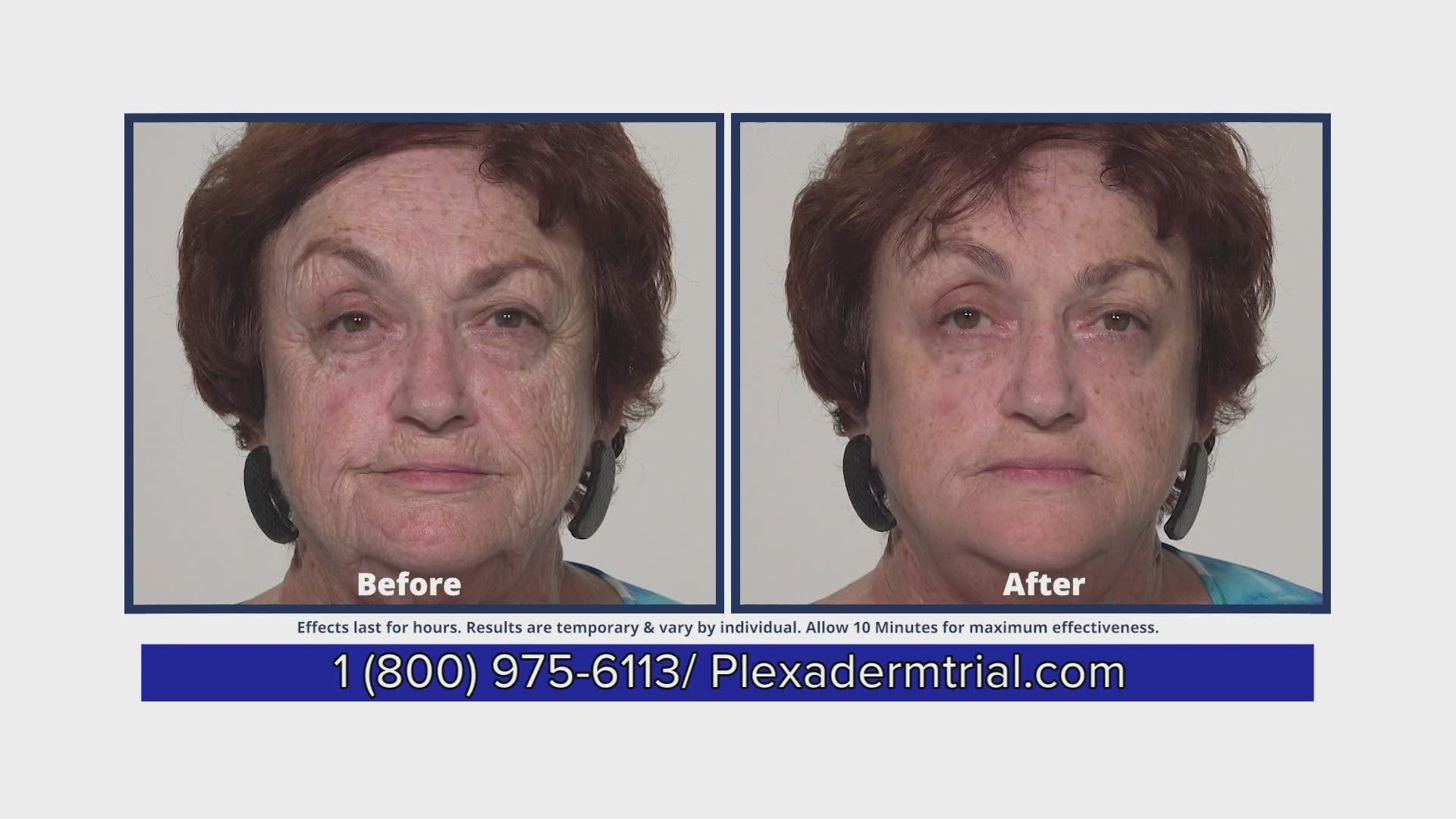 See how Plexaderm can shrink your under-eye bags and wrinkles from view.