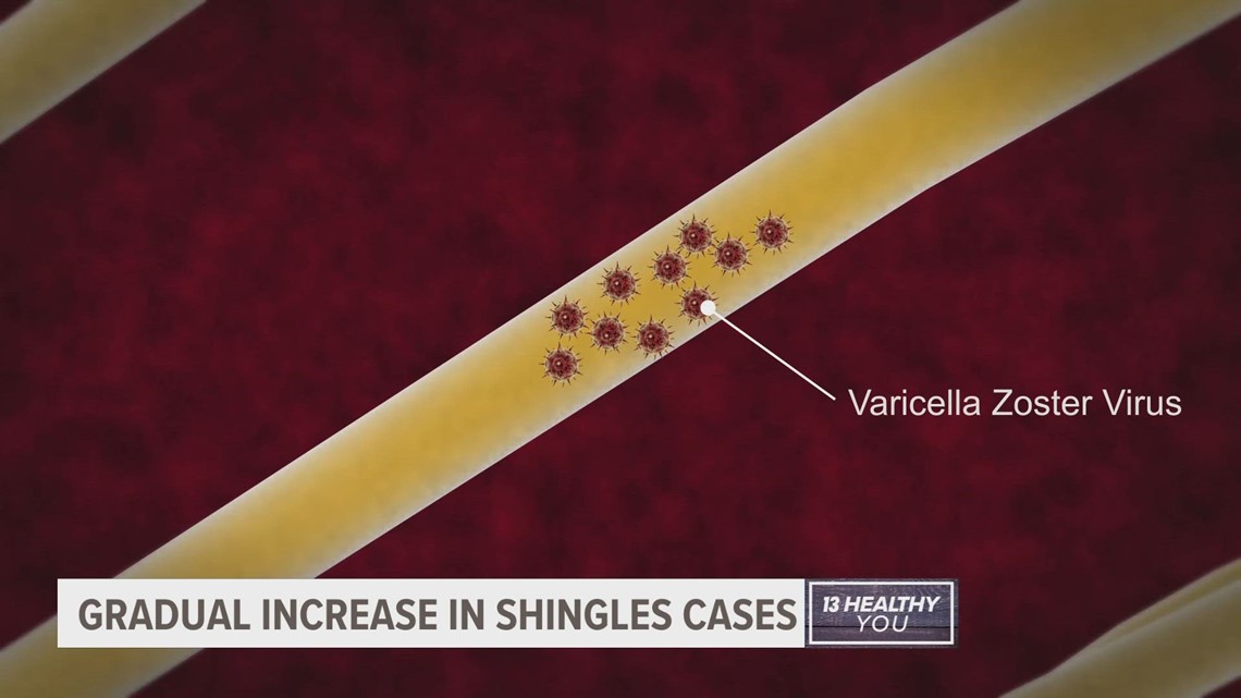 Why shingles cases are gradually increasing