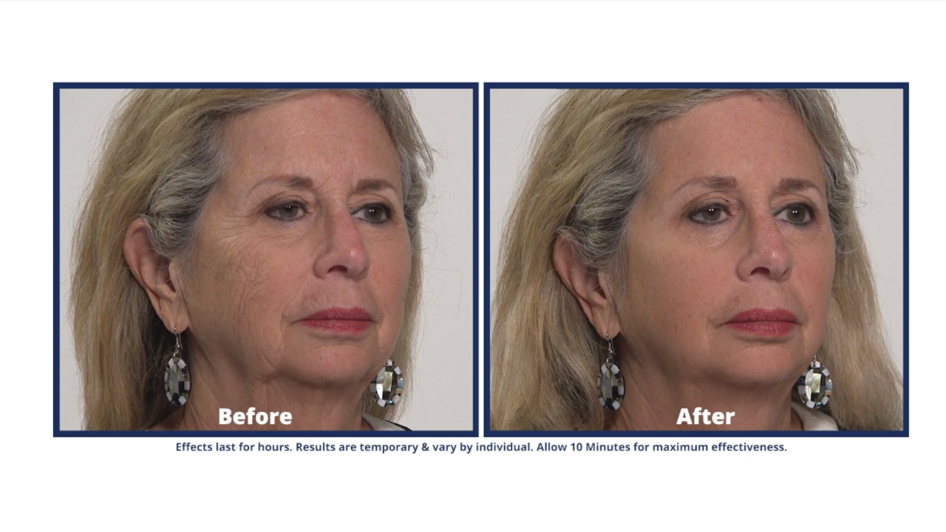 See how Plexaderm can help you look younger.