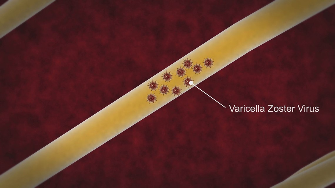SHINGLES What to know as cases are increasing