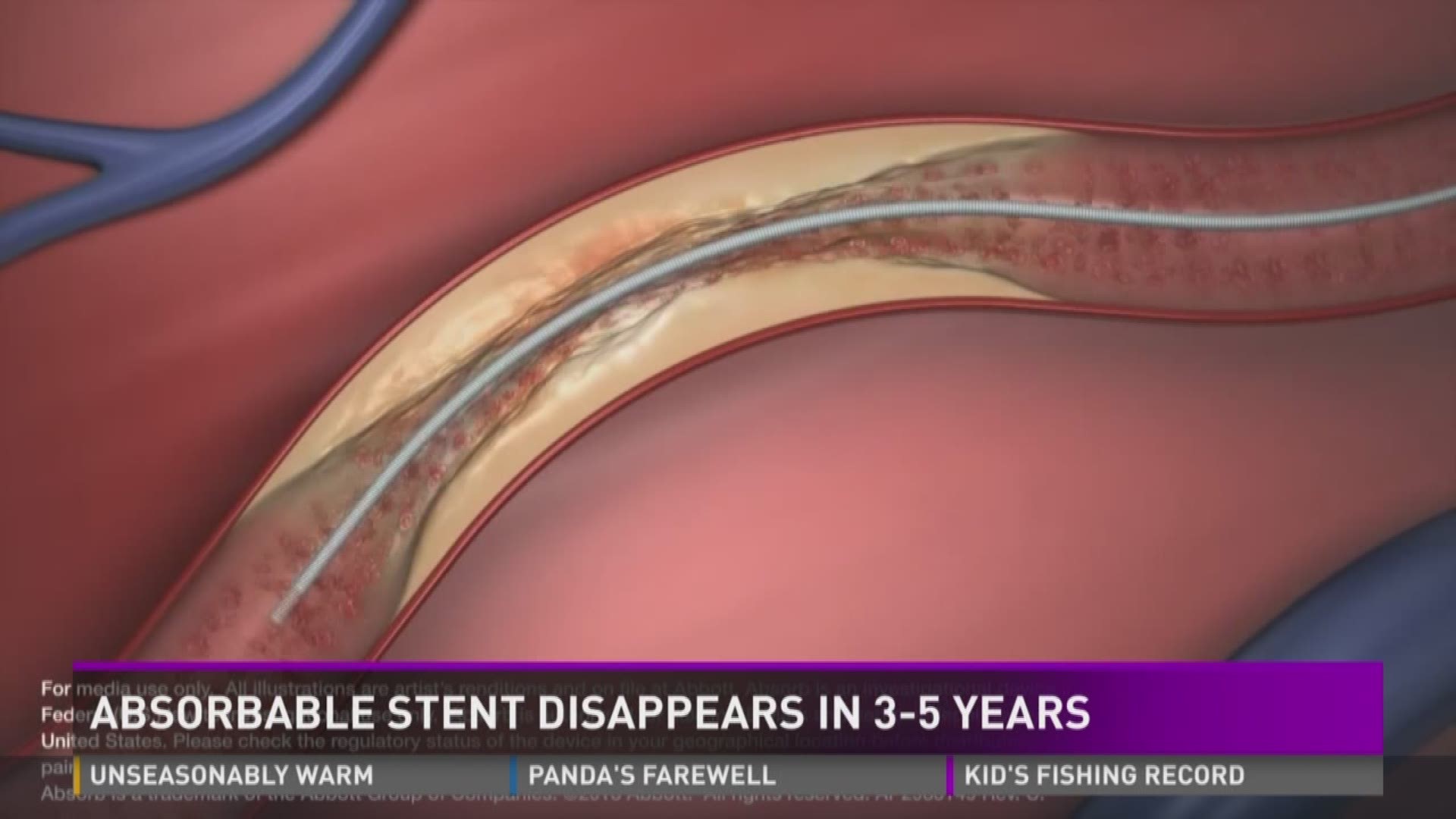 The new stent dissolves over time until it is completely gone after 3-5 years.