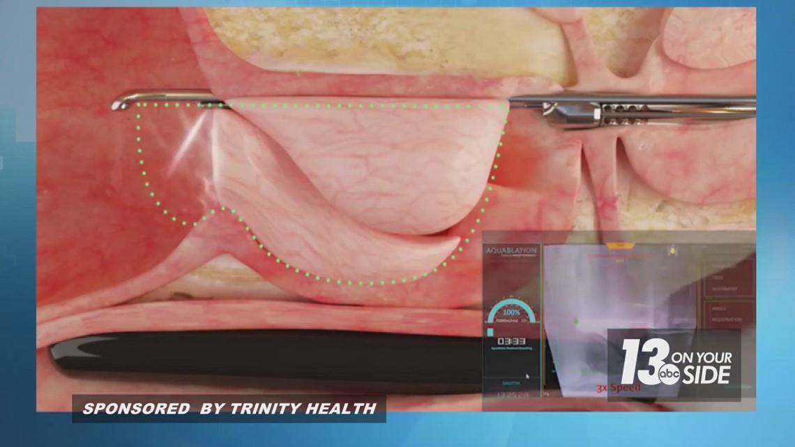 Aquablation therapy may be the answer to male urination challenge