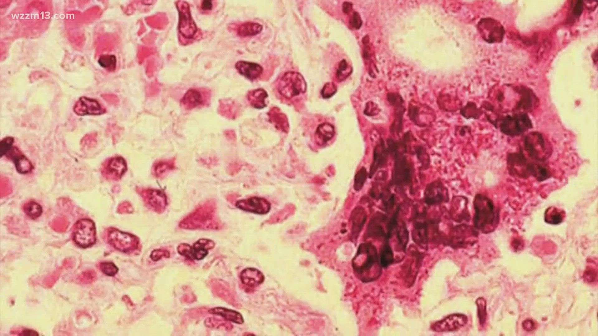 Michigan's 1st confirmed measles case