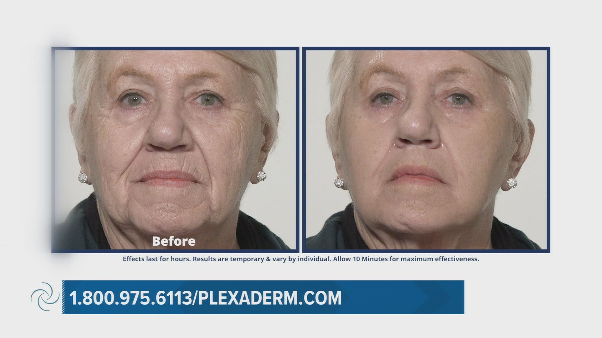 Plexaderm can help you look years younger