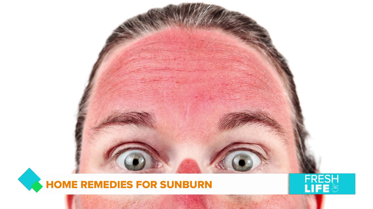 Check out these home remedies for sunburn